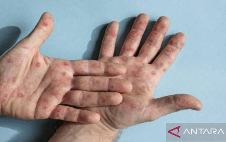 Ilustrasi - Infeksi Mpox. (ANTARA/HO-Shutterstock)