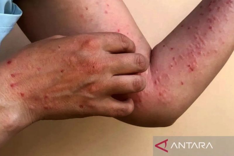 Ilustrasi - Cacar monyet atau Mpox. ANTARA/Shutterstock/am.