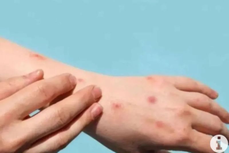 Ilustrasi - Cacar Monyet atau Monkeypox. (ANTARA/freepick/pri)