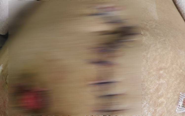 Tangkapan layar kondisi pasien dugaan Malapraktik Medis di RSUD Doris Sylvanus Palangka Raya (Foto:MARINI)