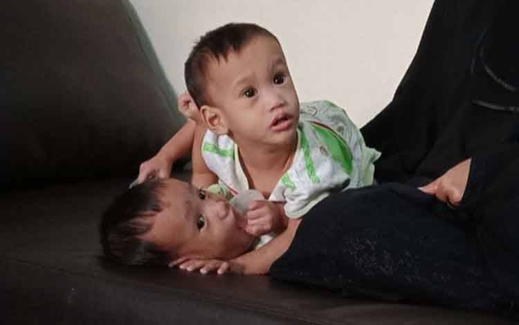 Bayi Kembar Siam akan Dioperasi Maret 2021