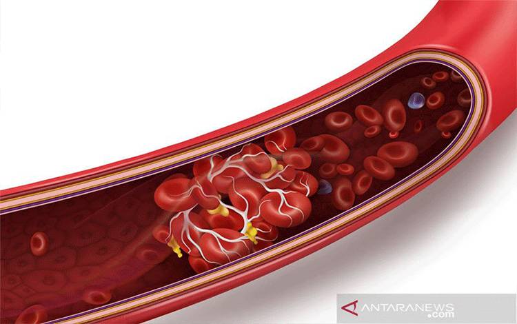 Inggris Temukan 30 Kasus Pembekuan Darah Terkait Vaksin AstraZeneca