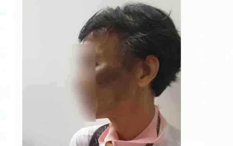 Wanita Asal Lampung Disiksa Majikan di Malaysia