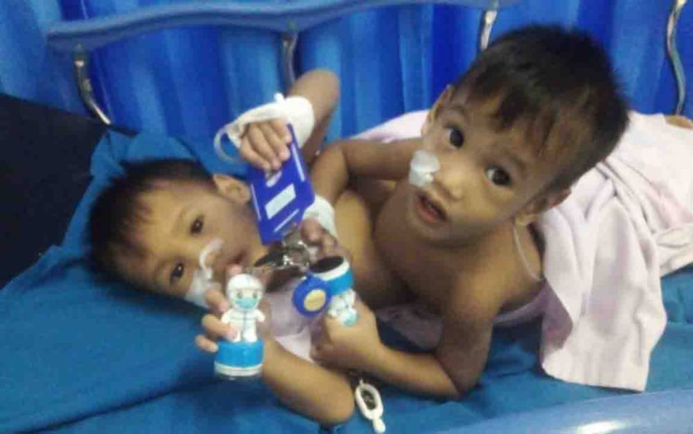 Balita Kembar Siam Asal Kobar Mulai Jalani Operasi