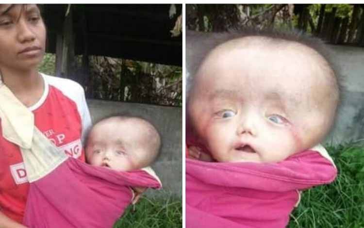 Anak Pemulung di Palangka Raya Menderita Hidrosefalus, Wali Kota Siap Bantu
