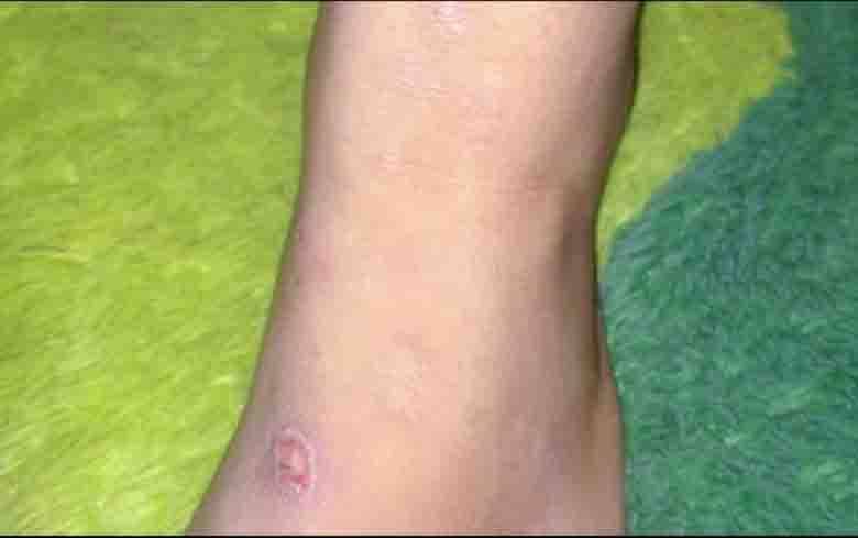 Penyakit Scabies Merebak, Dinas Kesehatan Kobar Diharapkan Turun ke Lapangan
