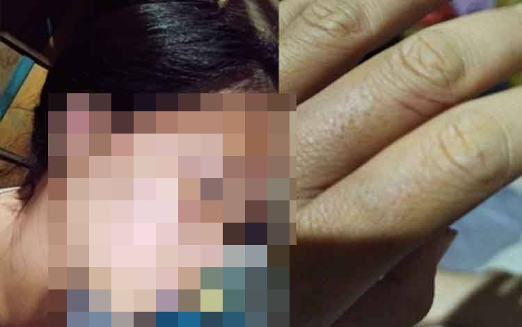 Babak Belur Dianiaya Pacar, Wanita Ini Lapor ke Polisi