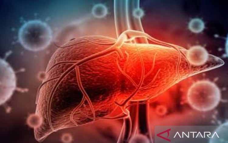 PB IDI: Hepatitis Akut Berjumlah 170 Kasus Dibeberapa Negara