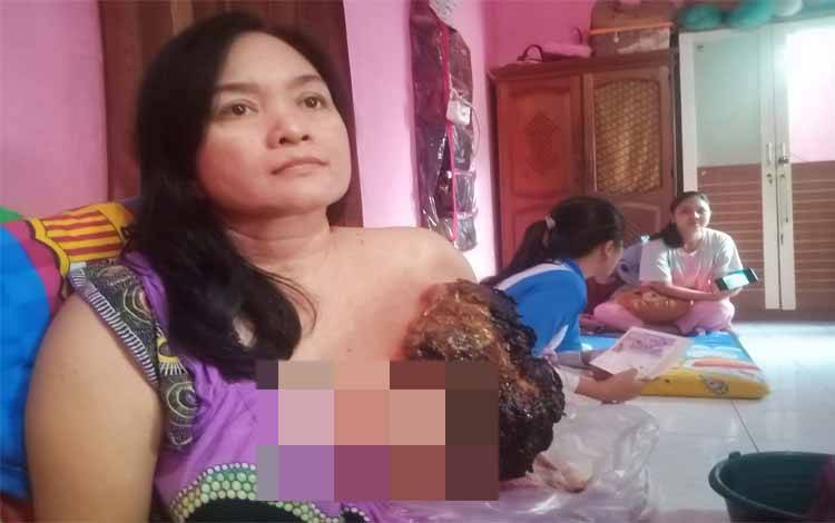Janda 5 Anak Idap Kanker Payudara Stadium 3