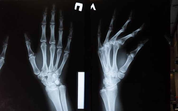 Dokter Sebut Anak-anak Juga Bisa Alami Osteoporosis