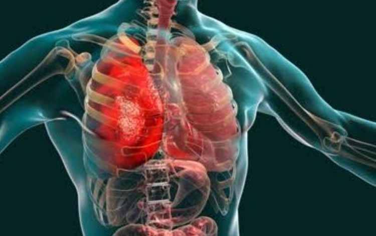 Dokter: Pneumonia Bisa Dicegah dengan Perbaiki Gizi dan Imunisasi