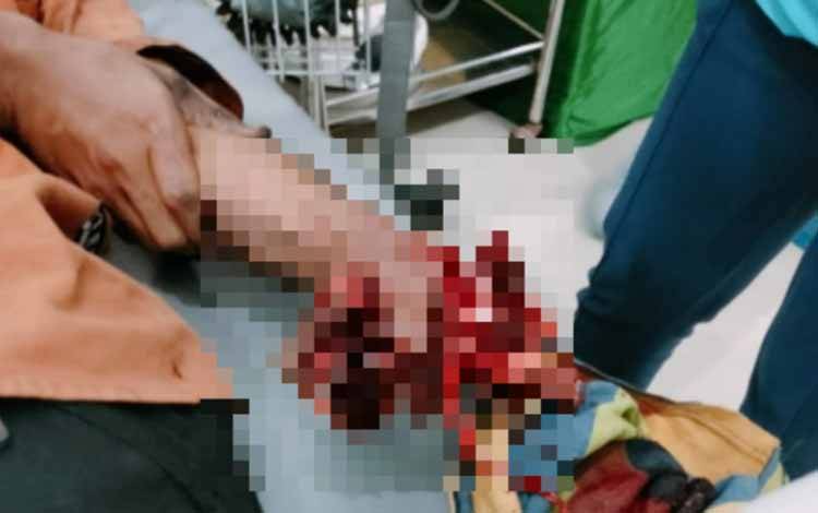 Tangan Pria Cedera Parah Akibat Petasan