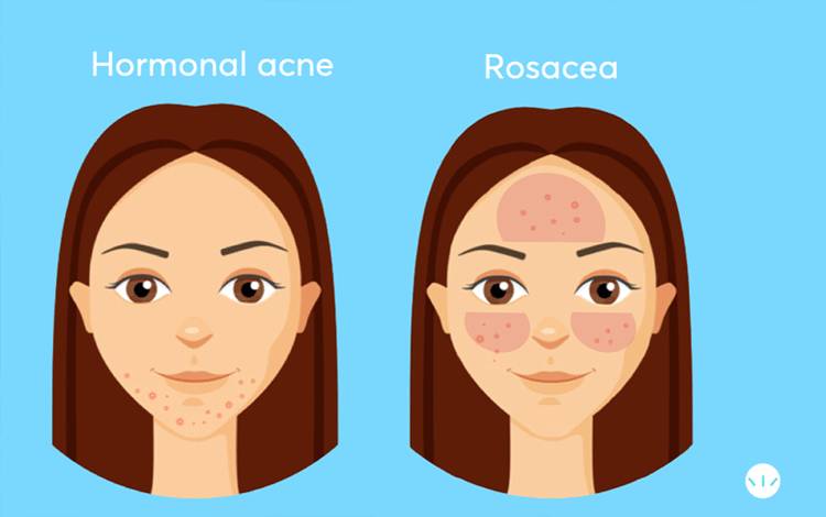 Mengenal Rosasea Lebih Dekat