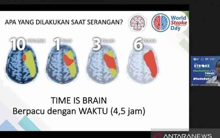 Dokter Ingatkan Stroke Harus Ditangani Tidak Lebih dari 4,5 Jam