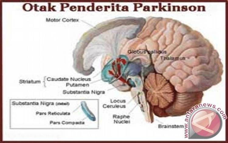 Dokter: Gaya Hidup Bisa Memunculkan Gejala Parkinson di Usia Muda